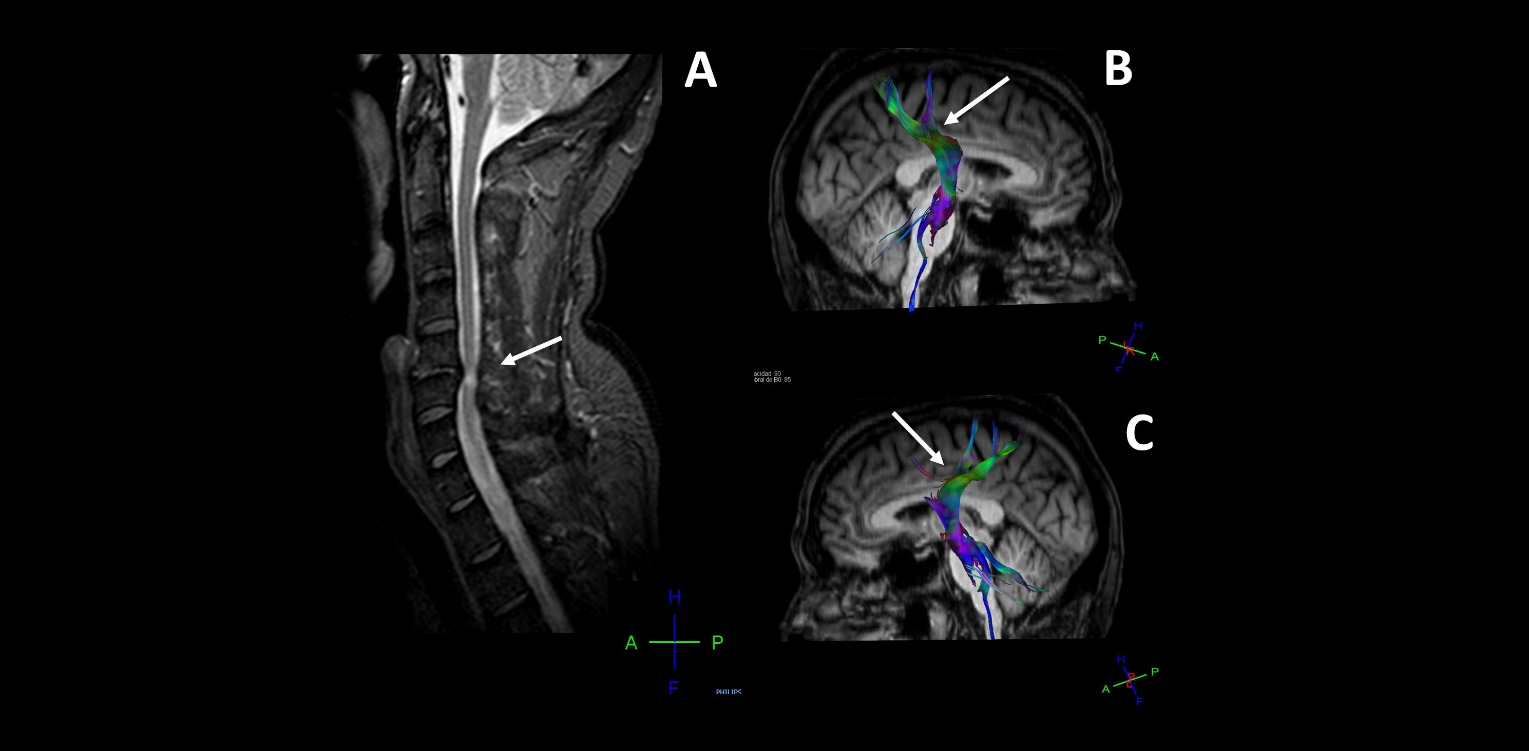 Detectan daño cerebral en pacientes con hernias cervicales mediante técnicas de neuroimagen e inteligencia artificial