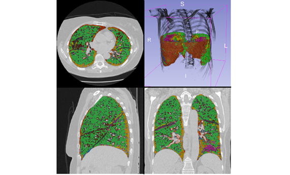 Identifican cambios en el tejido pulmonar de los fumadores que preceden a la enfermedad mediante análisis de datos