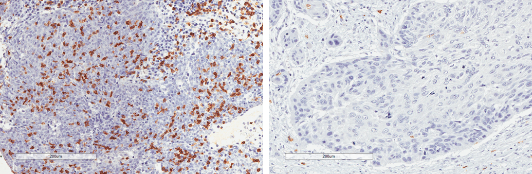 Demuestran el impacto del infiltrado inmune intratumoral en el pronóstico de carcinoma de cabeza y cuello no relacionado con VPH
