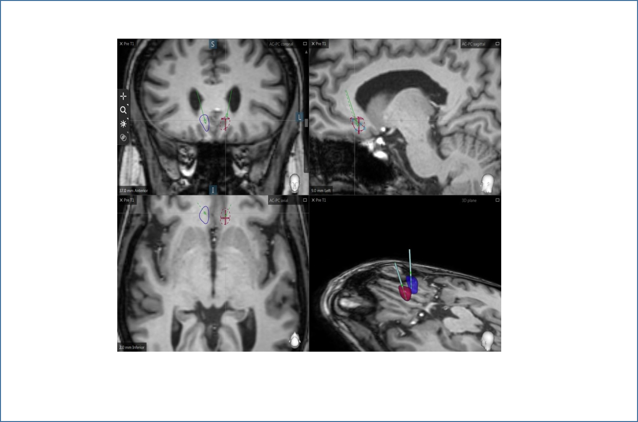 Realizan el primer estudio en el que se aplica la estimulación cerebral profunda (DBS) en pacientes con esquizofrenia resistente al tratamiento