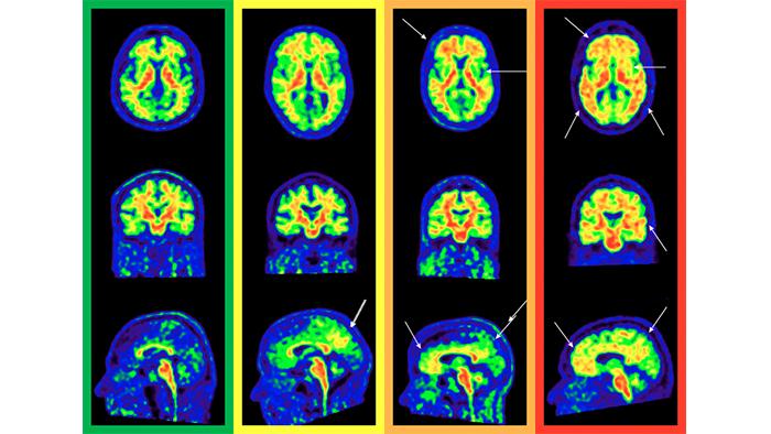 Investigadores europeos mejoran la sensibilidad del diagnóstico de las fases iniciales del Alzheimer