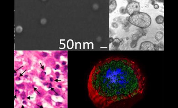 Identifican una nueva nanoterapia activa en células cancerosas resistentes a la quimioterapia