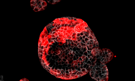 Identificadas las células responsables de la recaída en el cáncer de colon