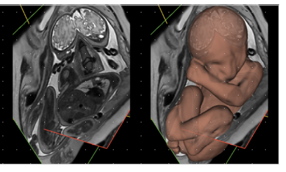 Un diagnóstico más fiable de anomalías fetales mediante reconstrucción 3D del útero materno