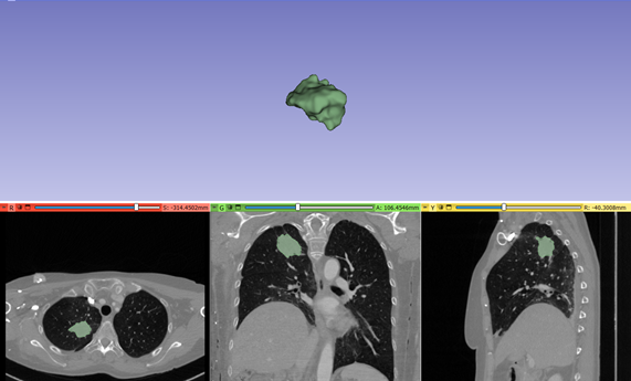 Cómo saber si un tratamiento para cáncer de pulmón es efectivo o no, a través de un biomarcador