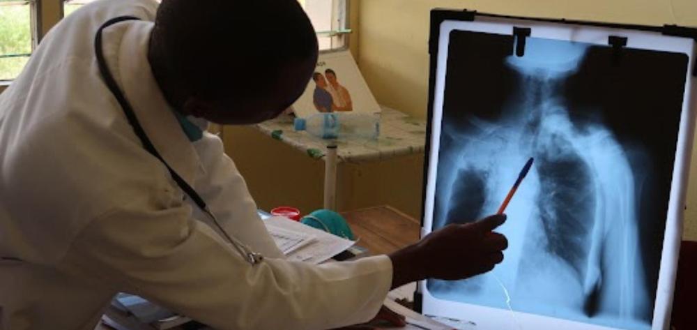 La tuberculosis resistente a fármacos podría estar infradiagnosticada, según un análisis genómico en el sur de Mozambique