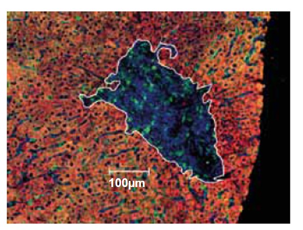 La hepatitis C puede ayudar a algunos pacientes trasplantados a adaptarse a su nuevo hígado