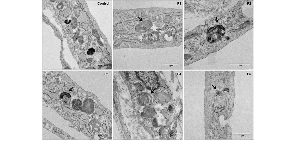 Describen un aumento del estrés oxidativo en individuos con enfermedad metabólica
