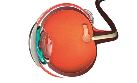 Desarrollan prótesis de retina basadas en grafeno